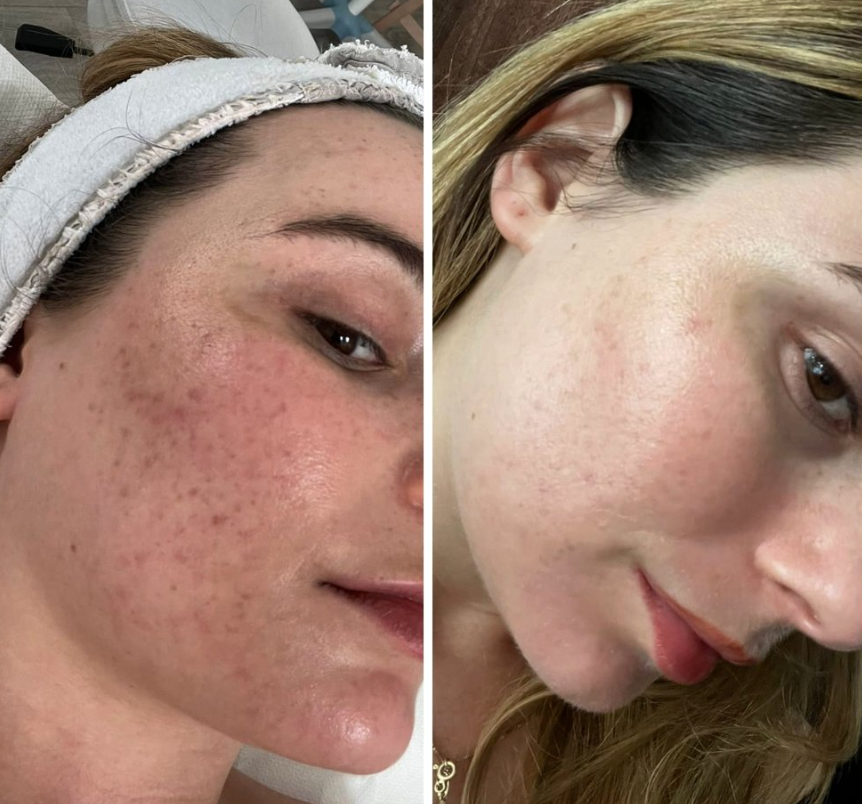 S8 Microneedling Pen +30 Cartridges & Serum Free - Limited Time Offer
