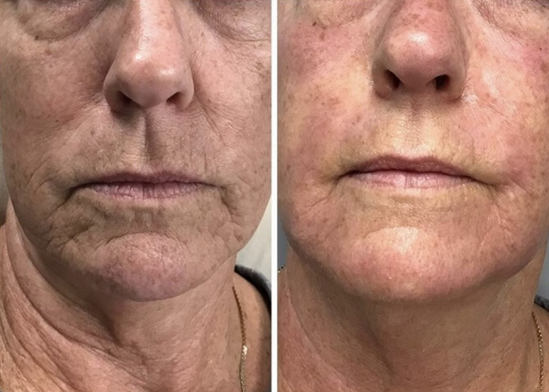 L3 Microneedling Pen +30 Cartridges & Serum Free - Limited Time Offer