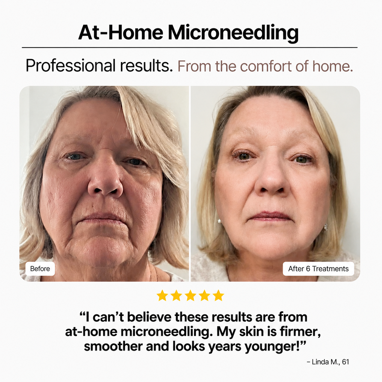Before and after comparison of a woman's face aftert at-home microneedling treatment.