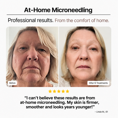 Before and after comparison of a woman's face aftert at-home microneedling treatment.
