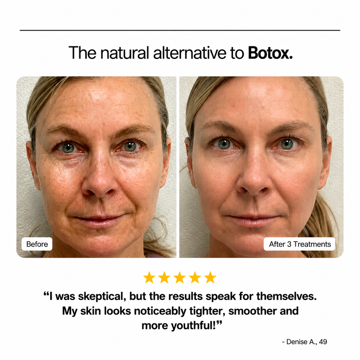 Before and after comparison of a woman's face with text about a natural alternative to Botox.